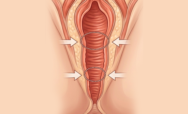 Illustration of vaginal tightening