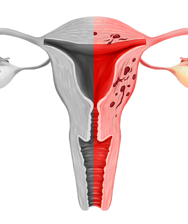 Normal uterus compared with adenomyosis