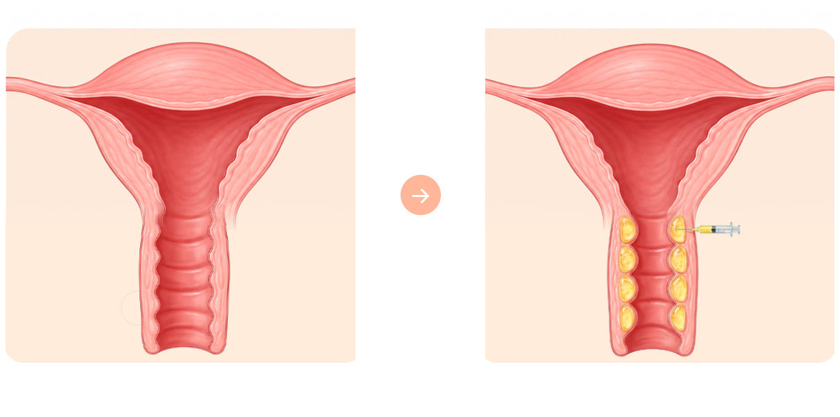 Illustrative diagram showing filler placed along the vaginal wall to restore volume